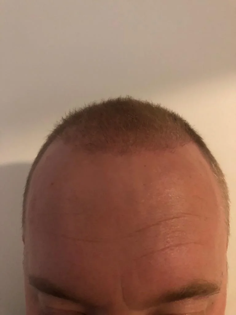 Jake 4 months post-transplant