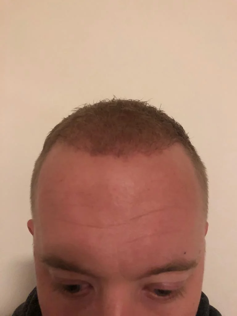 Jake 5 months post-transplant