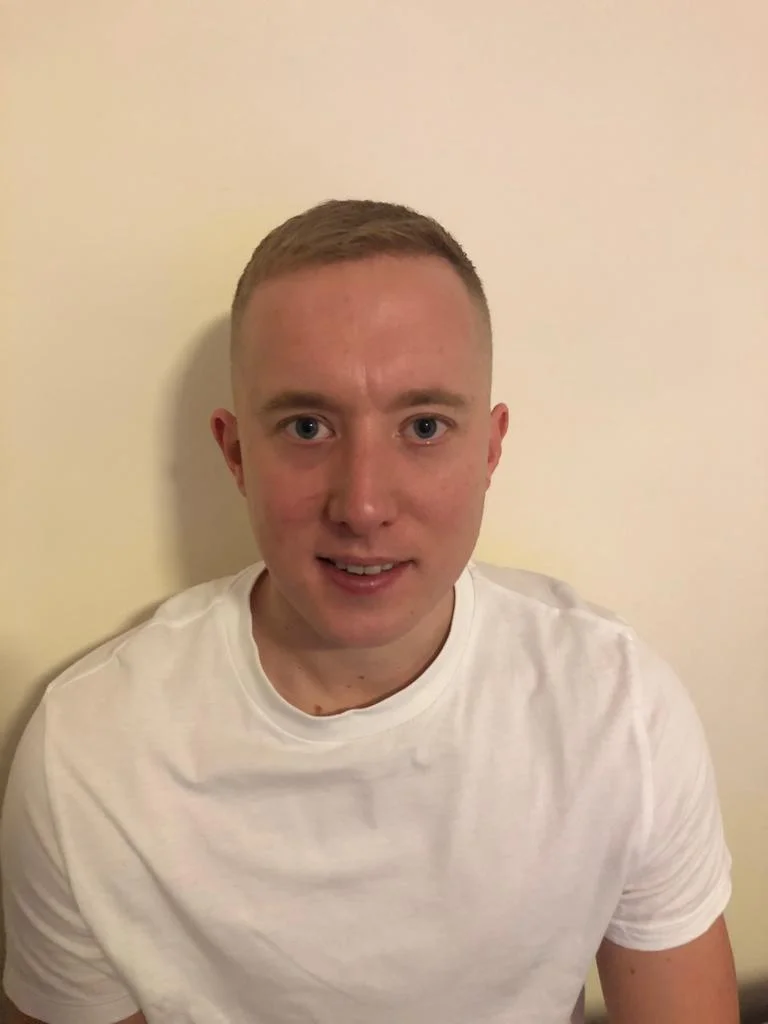 Jake 6 months after his FUE hair transplant