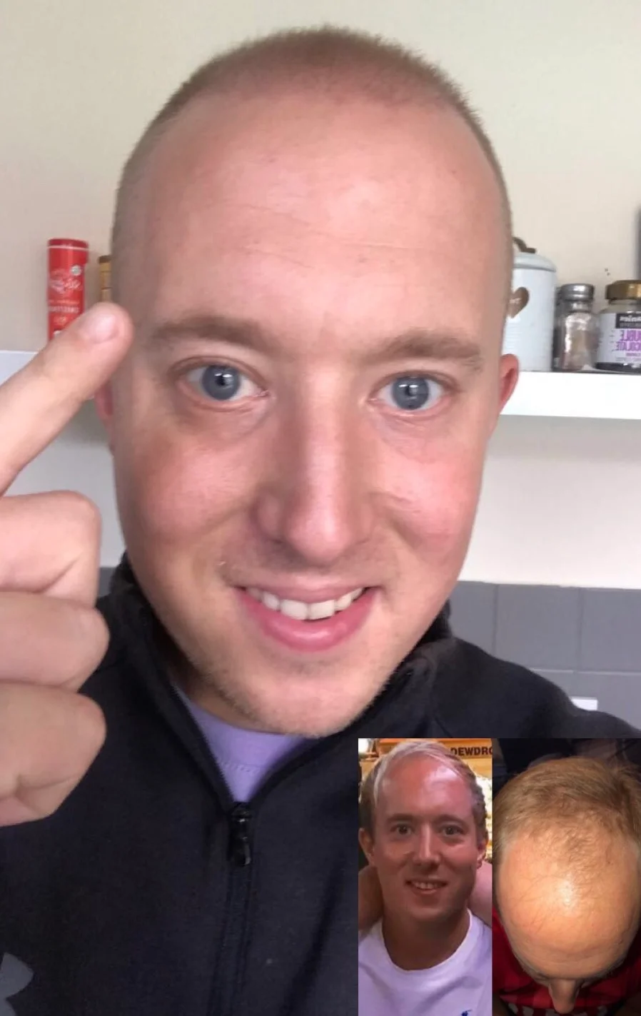 Jake on the day of his hair transplant