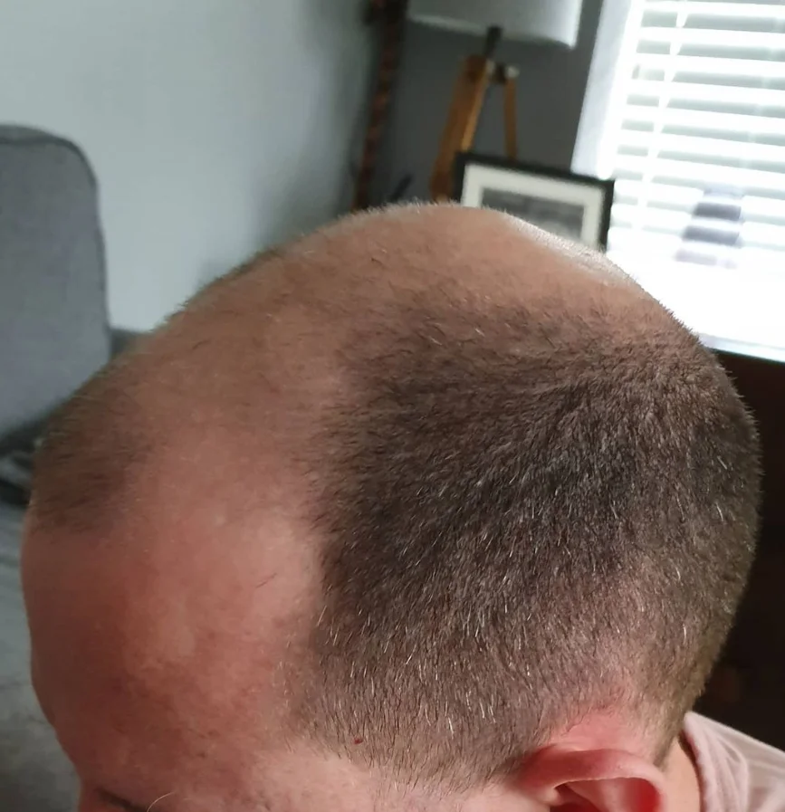 Marc before the procedure