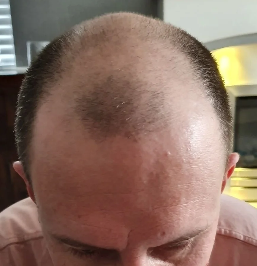 Marc before, alternate angle