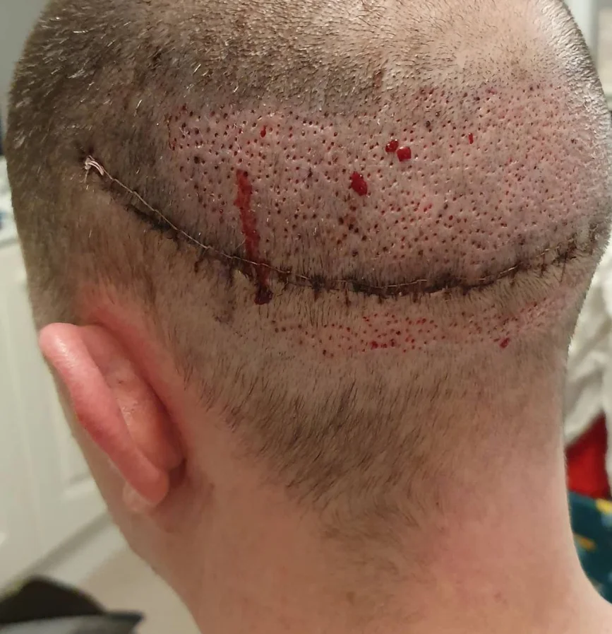 FUT donor area healed