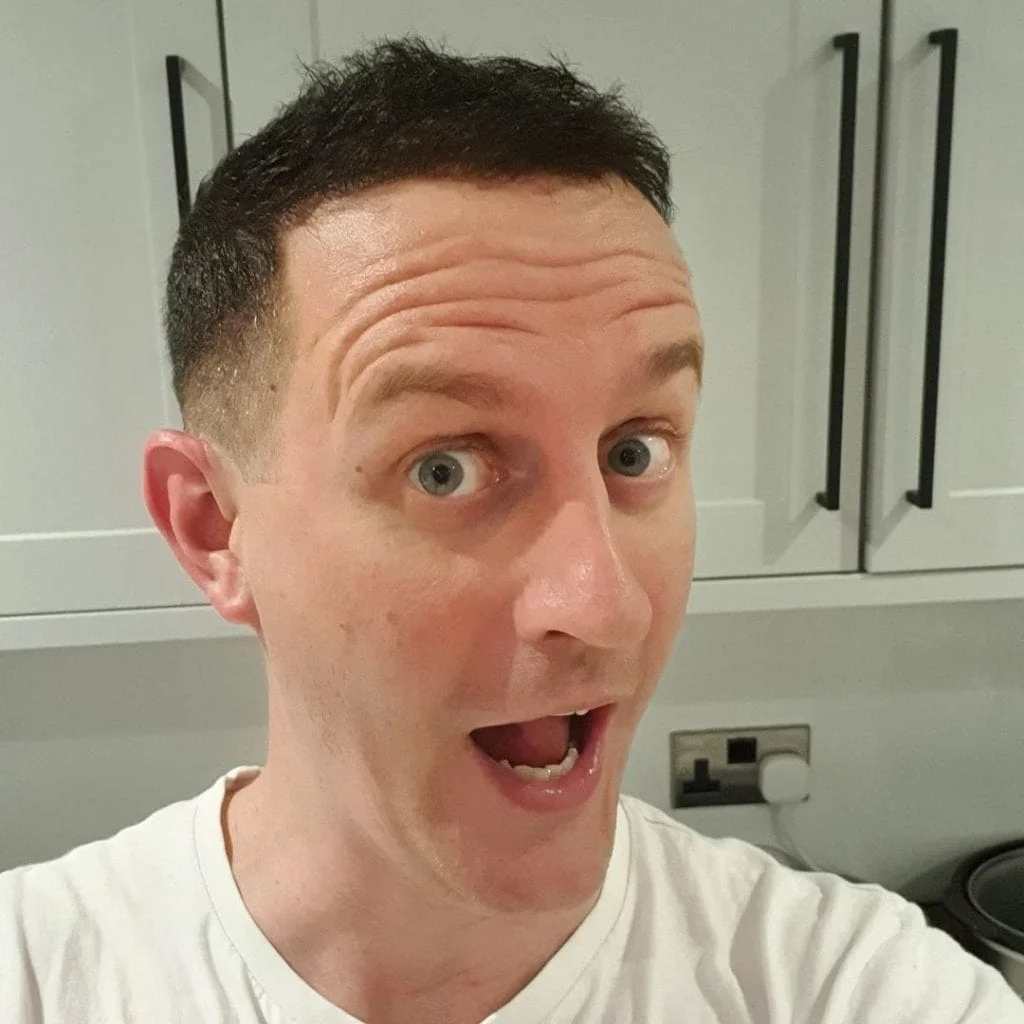 Marc after his hair transplant