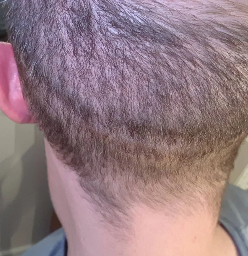 Combo procedure, view 6