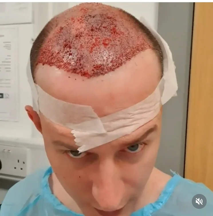 Marc during hair transplant surgery