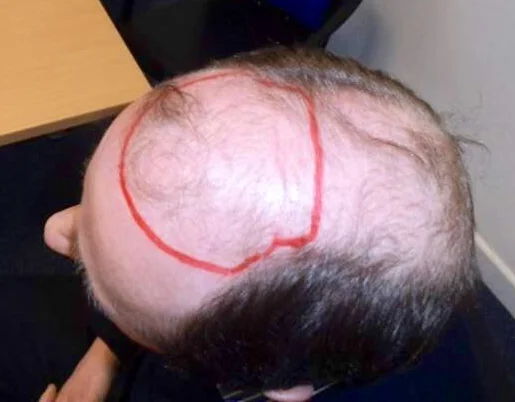Michael Kaye before the procedure