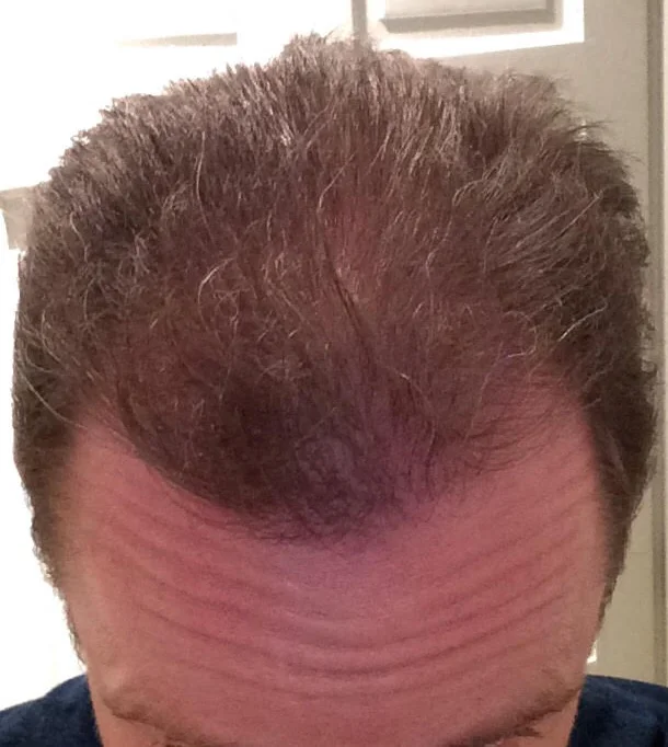 Michael 12 months after the procedure