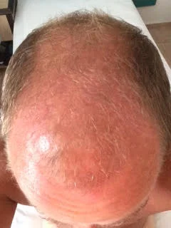 Michael 6 months after the procedure