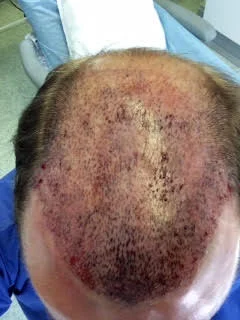 Michael immediately after the procedure